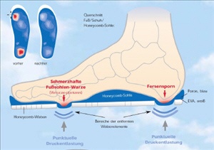 The Promed Honeycomb sole relieves the foot in the desired areas